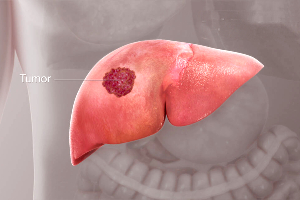 best Liver cancer treatment in Bangalore