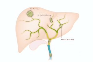 Cholangiocarcinoma, Choledochal Cyst surgery in Bangalore- bile duct cancer