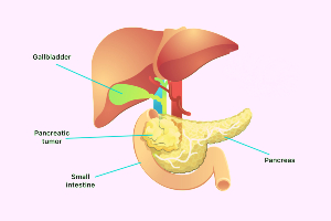 The procedure of Pancreatectomy for Pancreatic Tumor removal and Pancreatic cancer treatment in Bangalore
