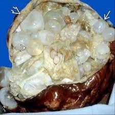 The Symptoms of Hydatid Cyst are