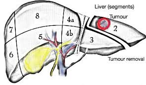 Liver tumour removal in Bangalore