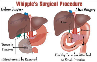Whipple's Resection in Bangalore